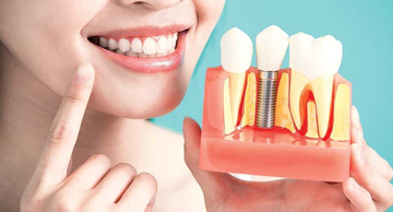 Diş implant fiyatları 2024