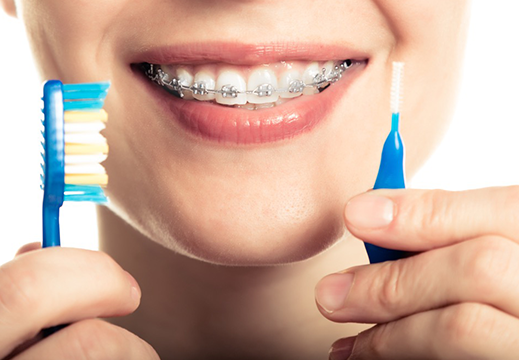 Diş Teli Takanlar İçin Ağız Bakım Önerileri