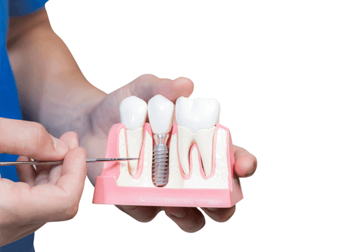 Dental İmplant Cerrahisinde En Çok Merak Edilen Sorular