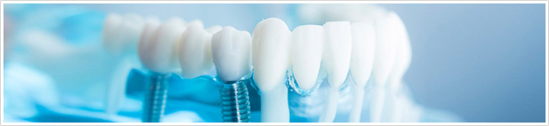 implant kaplama, Dentadent Bakırköy diş hastanesi, en iyi diş kliniği, diş hastanesi, en iyi endodontist,
