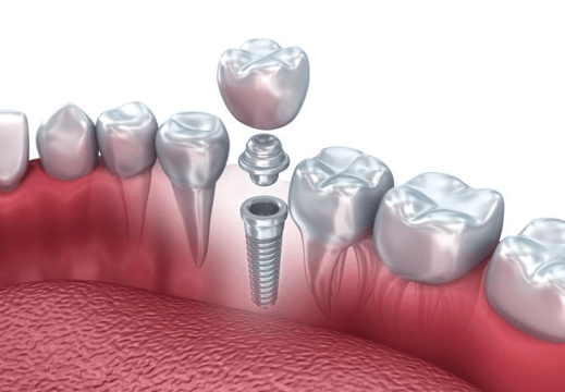 Best centre for dental implants in İstanbul