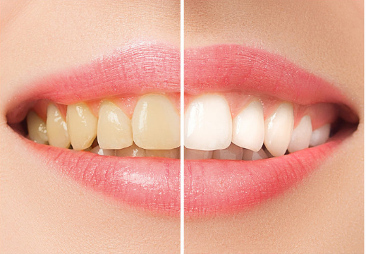 Diş beyazlatma Hakkında Merak Ettikleriniz
