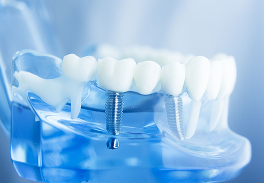 Dental Implant Uygulaması Hangi Durumlarda Yapılır?