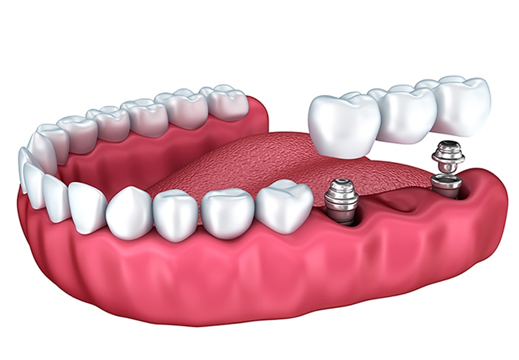 Implant Application in Turkey