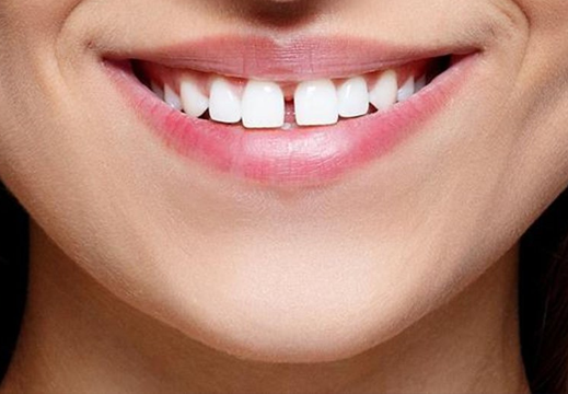 Dişler Arasındaki Boşlukların Tedavisi