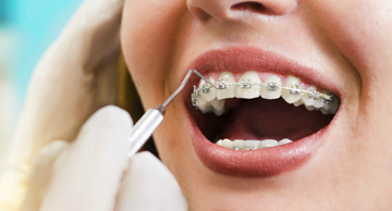 Ortodontik Tedavi Sonrası Dişler Bozulur Mu?